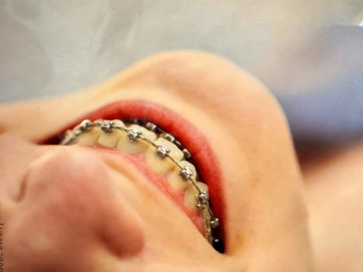 Ästhetische Korrektur - feste kieferorthopädische Zahnspange (KIG 1-2)