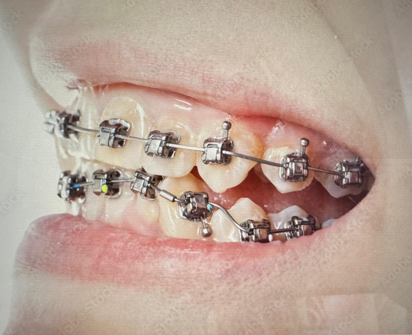 Ästhetische Korrektur - feste kieferorthopädische Zahnspange (KIG 1-2)