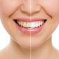 Profi-Bleaching "Happy Teeth" für strahlend weiße Zähne